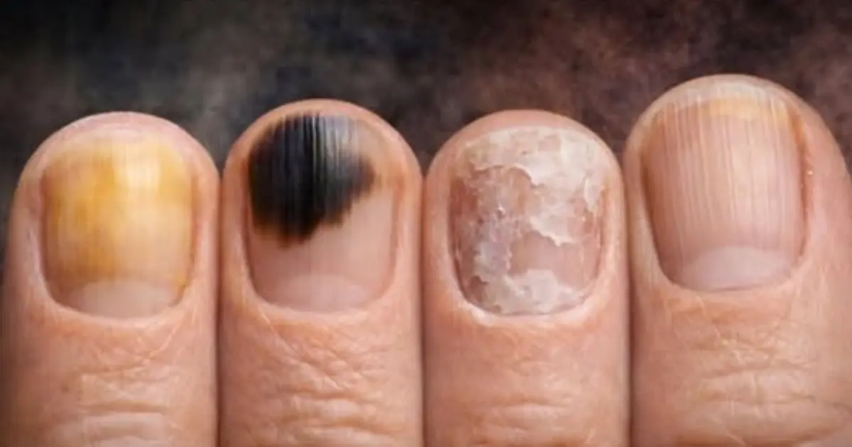 Lines, Ridges, or Discoloration on Your Nails? Here’s What to Watch For
