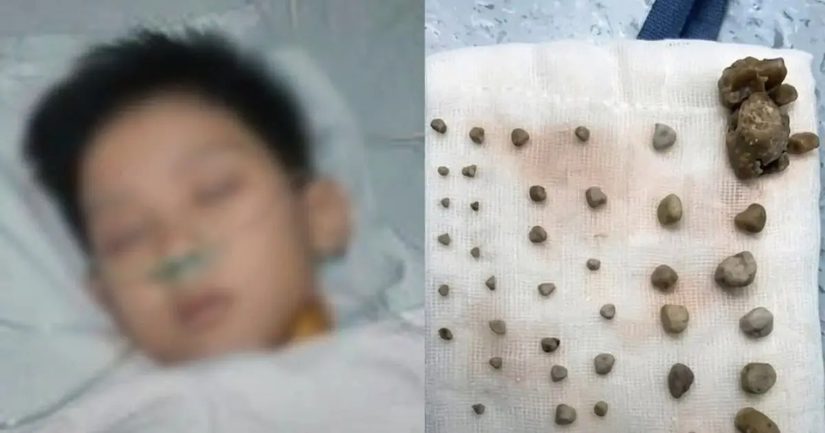 9-Year-Old Boy Found With 56 Stones in His Abdomen: Doctors Trace the Cause to a Daily Habit