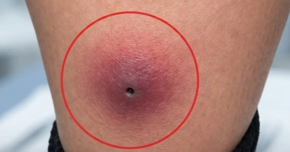 They Thought It Was Only the Flu! After Pulling Up a 12-Year-Old Boy's Pant Leg, the Doctor Immediately Sent Him to the ICU.