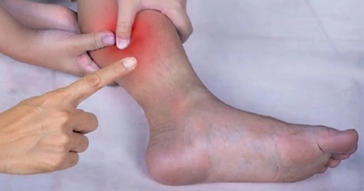 Could Nighttime Leg Cramps Signal an Underlying Health Issue?