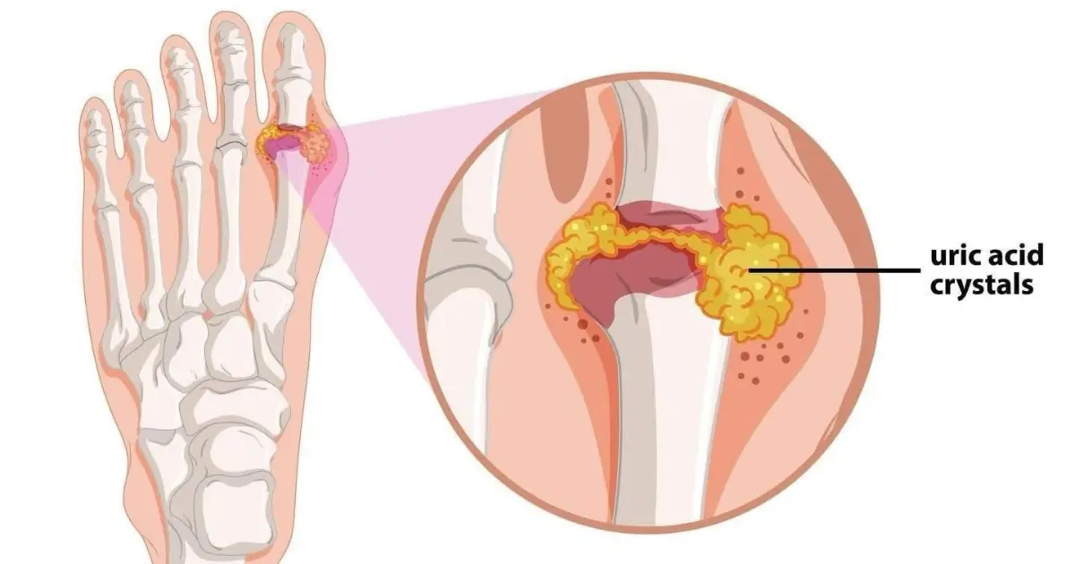 The Fastest Ways to Reduce Uric Acid Levels and Lower the Risk of Gout