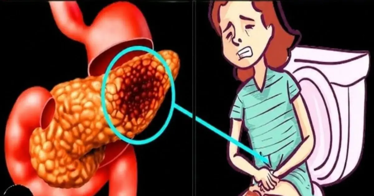 15 Silent Signs of Pancreatic Can.cer You Should Never Ignore