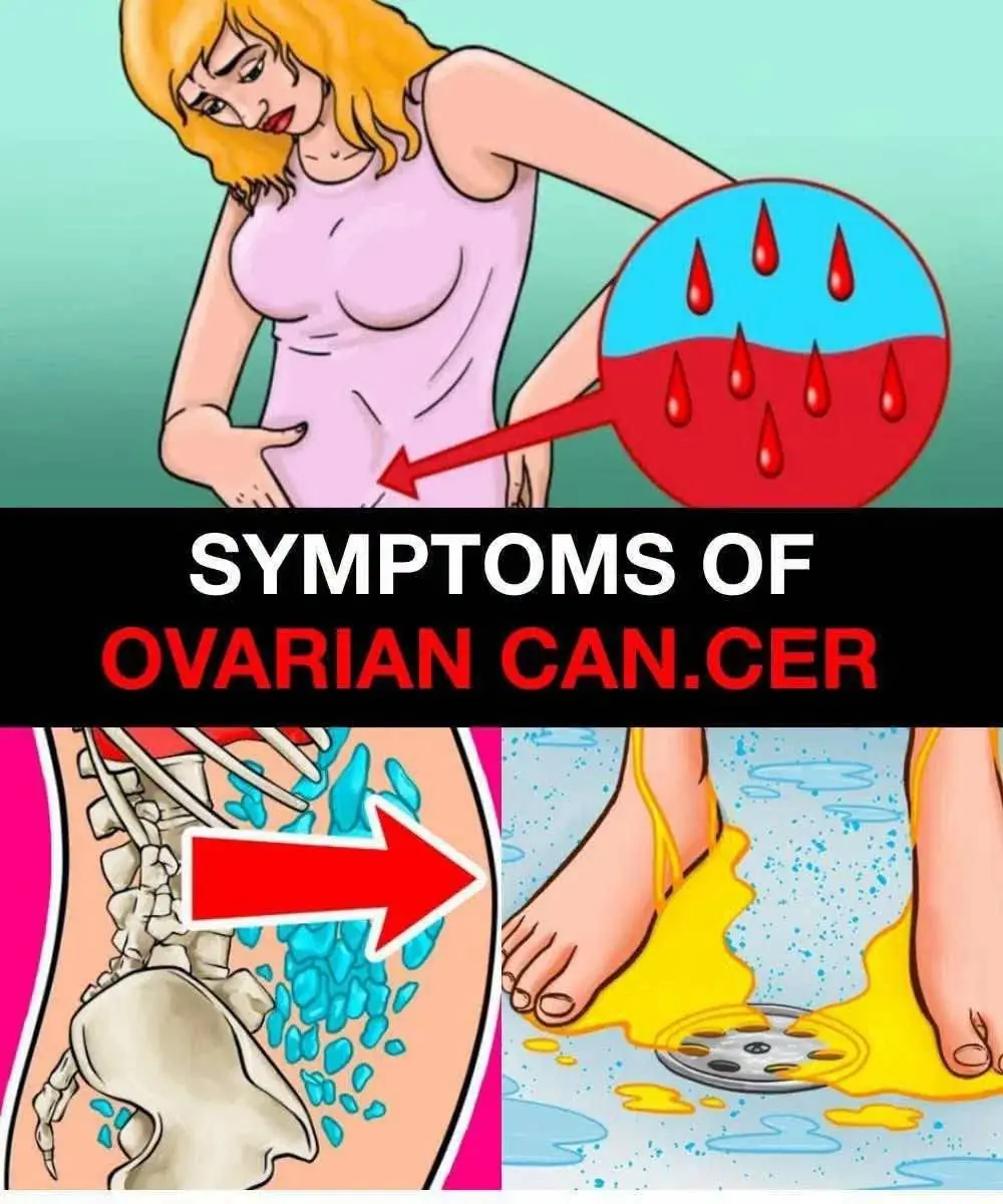 Symptoms of Ovarian Can.cer... See more in 1st comment
