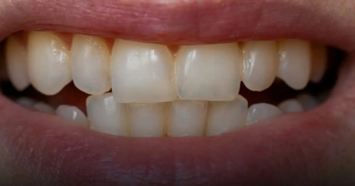 Dentist Explains the 7 Biggest Reasons Teeth Turn Yellow — And How to Keep Your Smile Bright