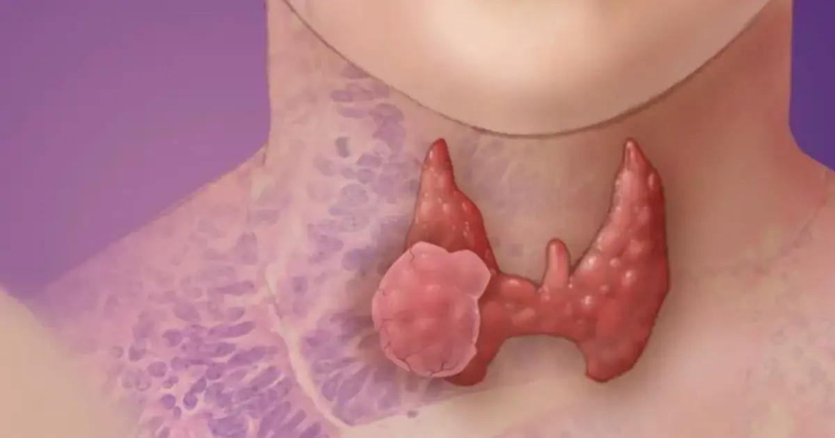 Thyroid Can.cer: 5 Early Signs You Should Be Aware Of