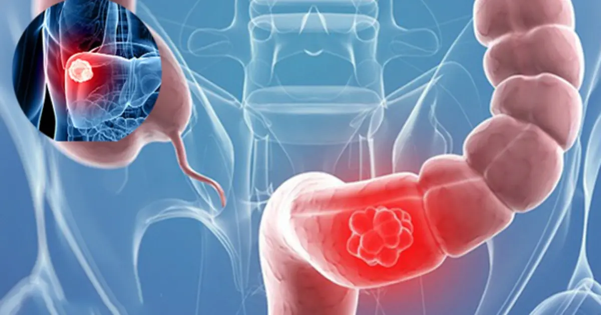 Possible Early Signs of Colon Can.cer Your Body May Be Trying to Tell You About