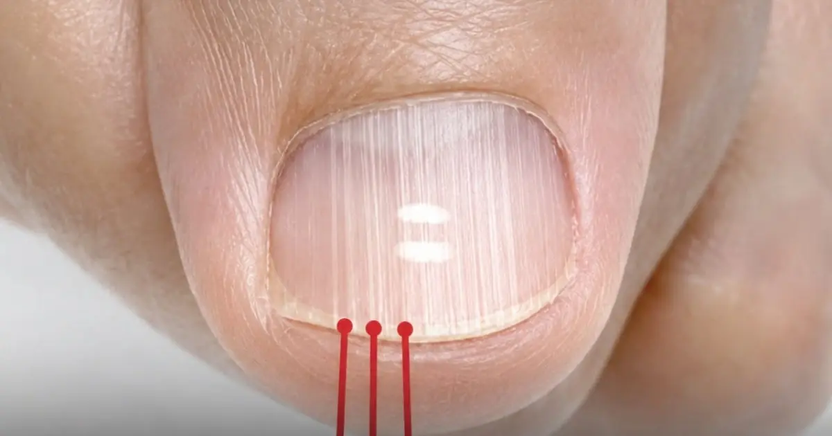 If You Notice These Vertical Lines on Your Nails After 40, Here’s What They May Mean