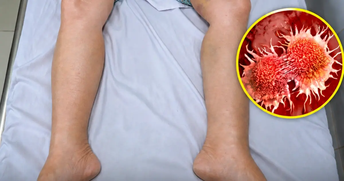 She Ignored a Tiny Warning Sign for Months—By the Time Doctors Found the Cause, the Disease Had Reached Stage 4