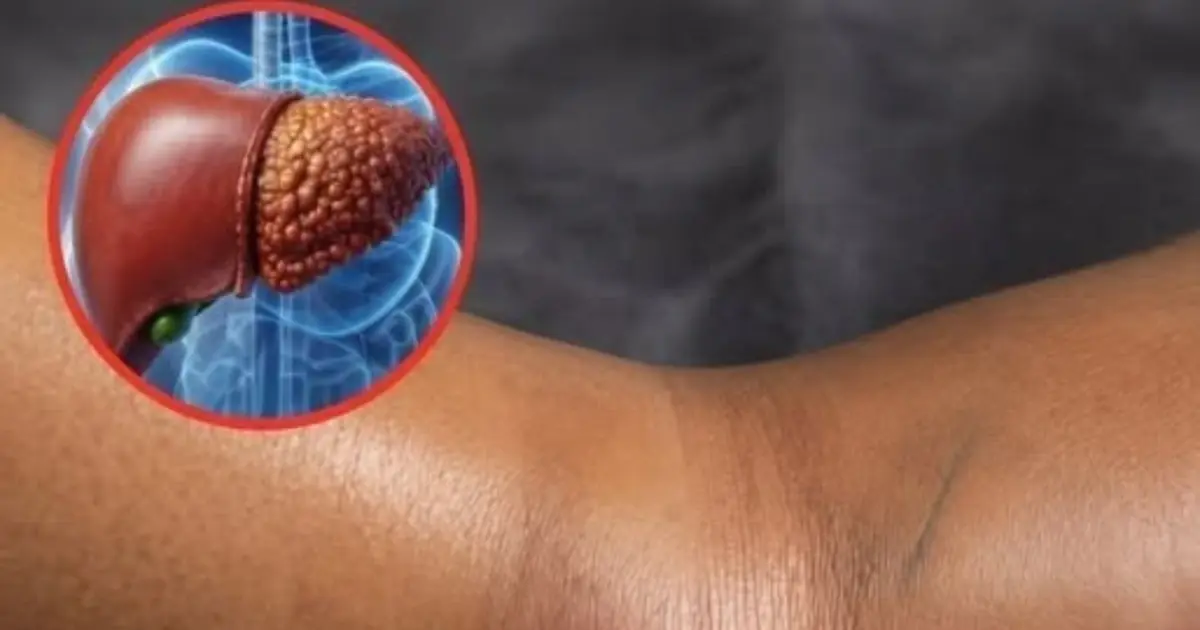 Swollen Legs: When They Could Be a Warning Sign of Liver Disease
