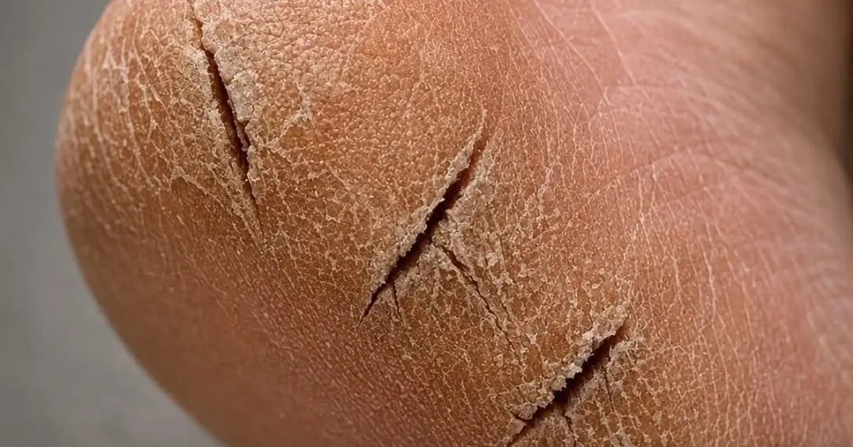 Got Thick, Cracked Heels? This One Simple Solution May Help Soften Rough, Peeling Skin