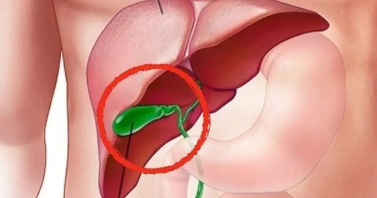 Doctors Explain What Can Change After Gallbladder Removal - 3 Possible Effects You Should Know