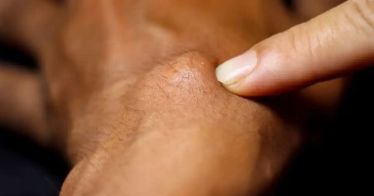 Is That Bump on Your Wrist Dangerous? What to Know About Ganglion Cysts
