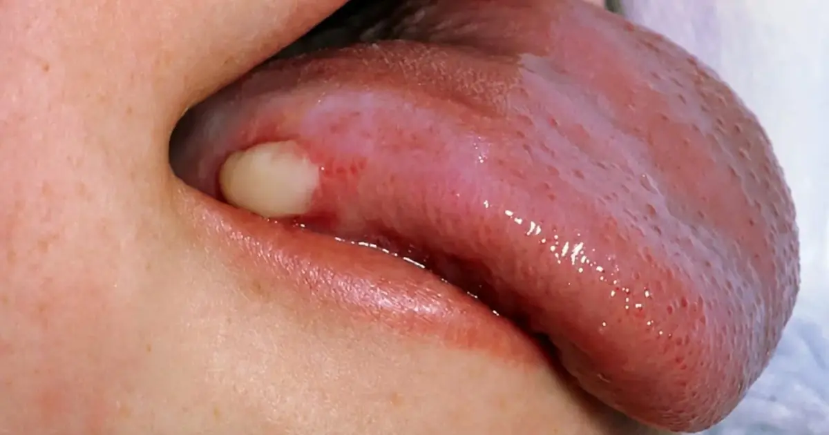 5 Warning Signs of Oral Can.cer You Should Never Ignore