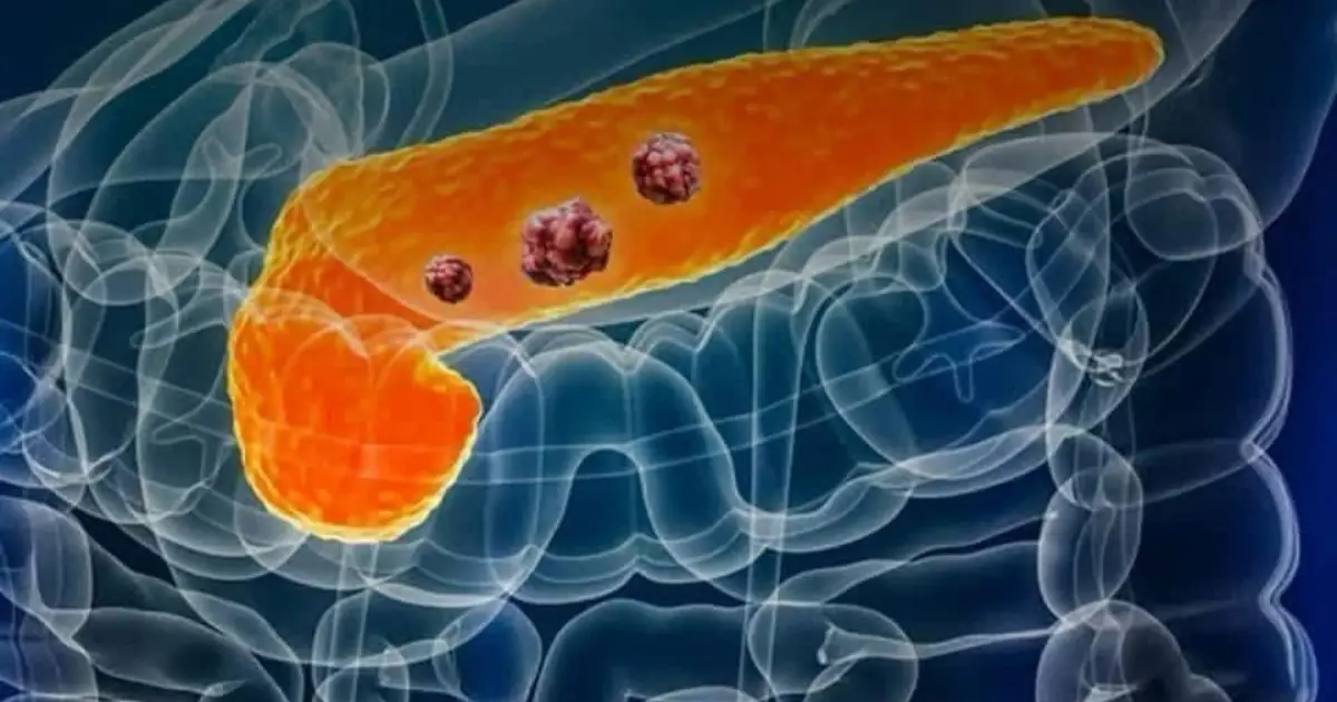 Pancreatic Cancer: Early Warning Signs You Should Never Ignore