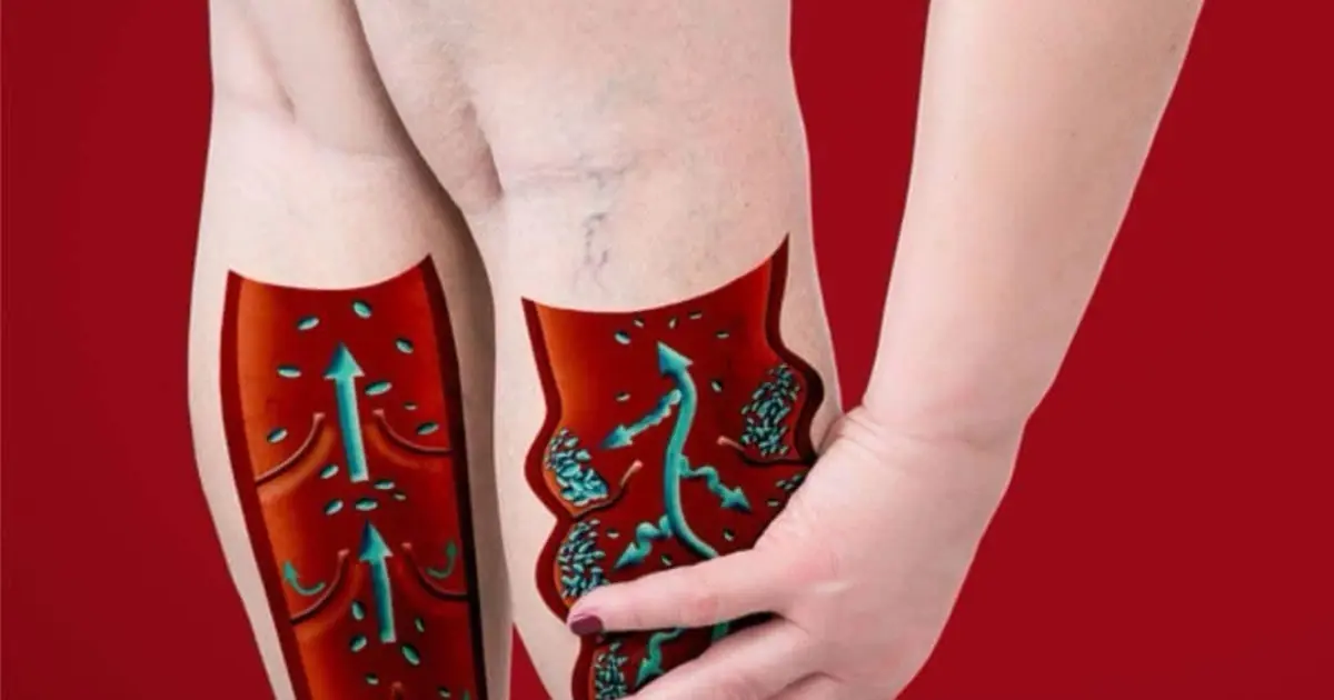 6 Simple Habits That May Help Improve Circulation and Support Vein Health