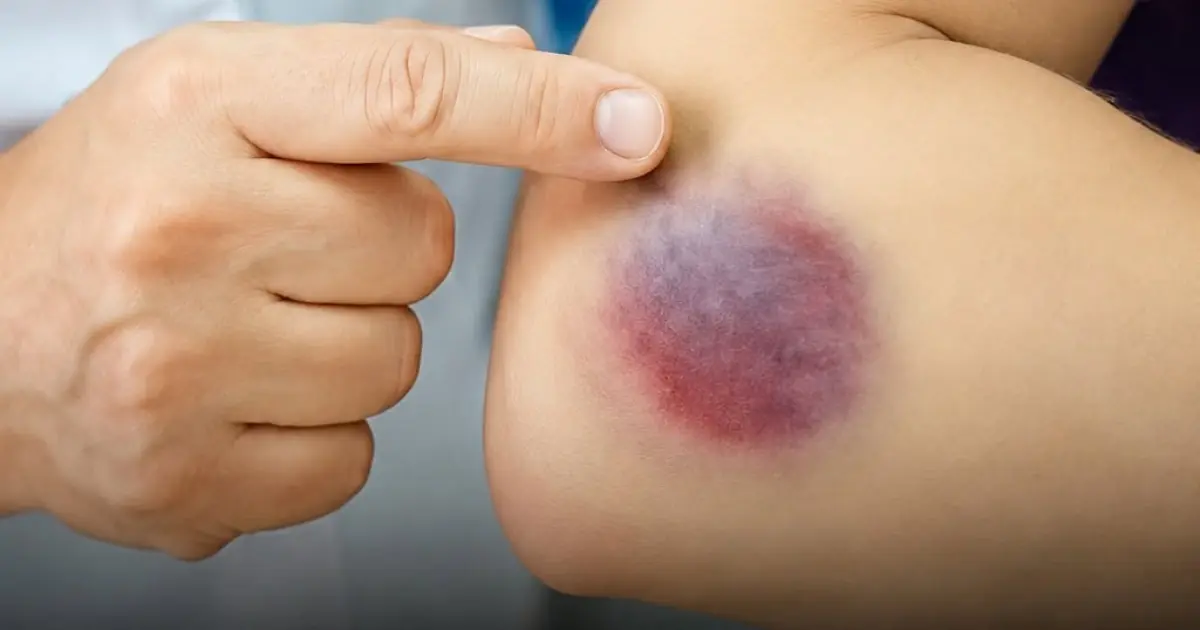 Bruises on Your Body May Be Warning You About an Underlying Health Problem