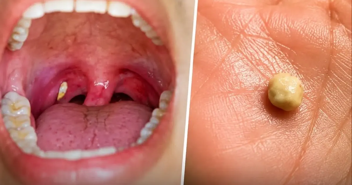 Suddenly Feeling Something Stuck in Your Throat? A Small Lump May Reveal More Than You Think