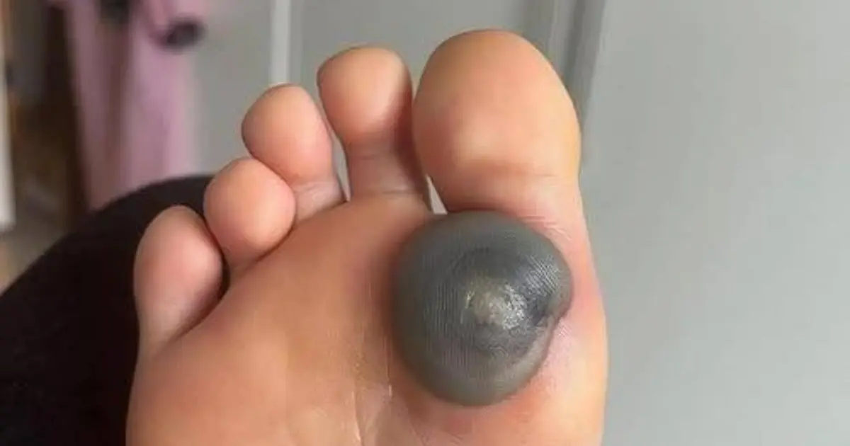 My Daughter Woke Up With This Unusual Mark on Her Foot - Should I Be Worried?
