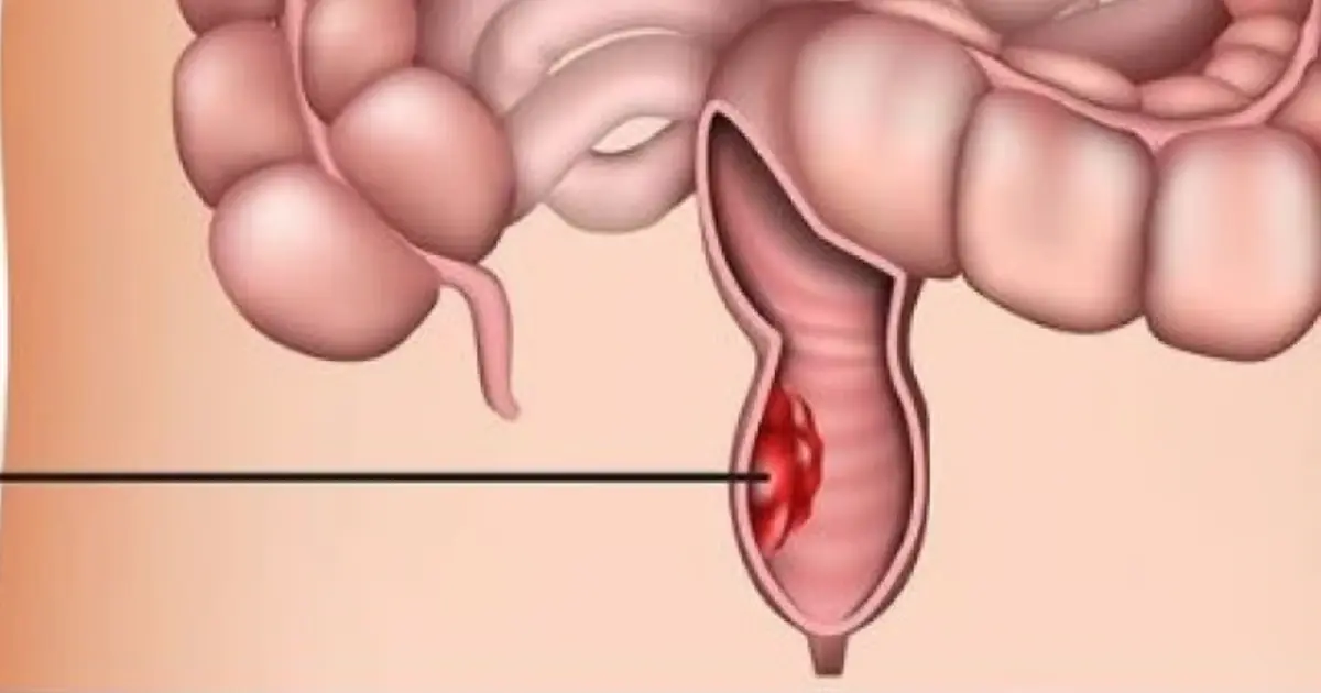 Have Colon Polyps? 4 Bowel Movement Changes You Shouldn’t Ignore
