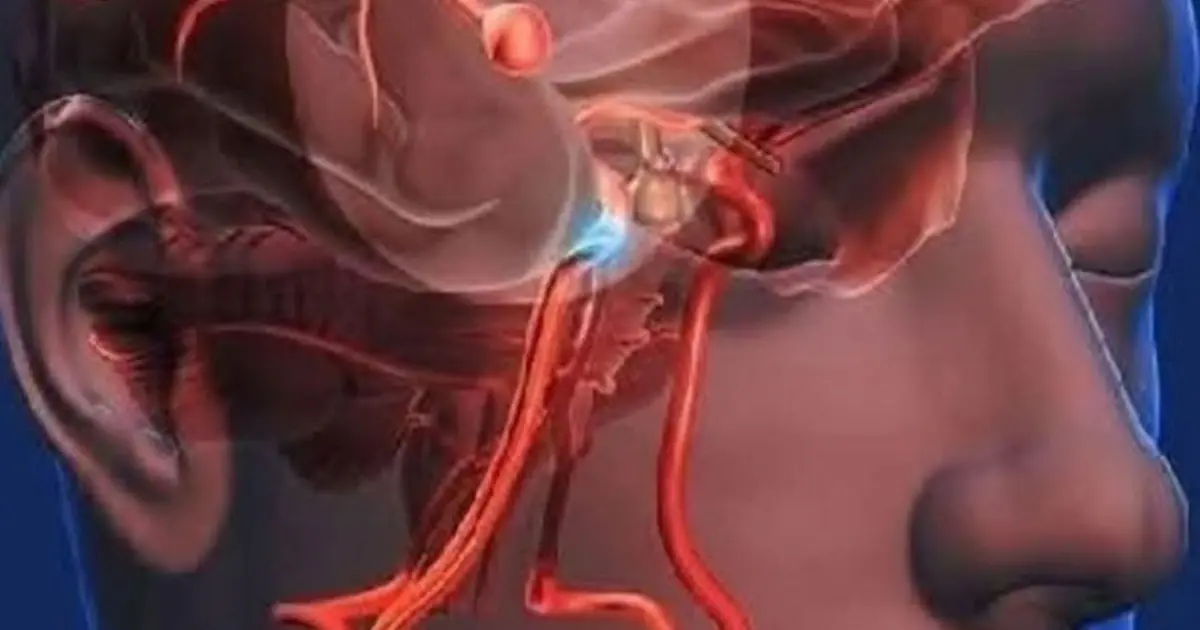 Aneurysm: Signs you shouldn't ignore... See more