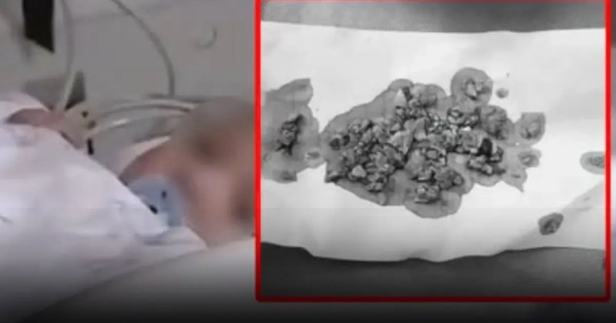 Doctors Were Shocked to Find a 5-Month-Old Baby’s Stomach Filled with Stones—The Hidden Cause Left Everyone Speechless