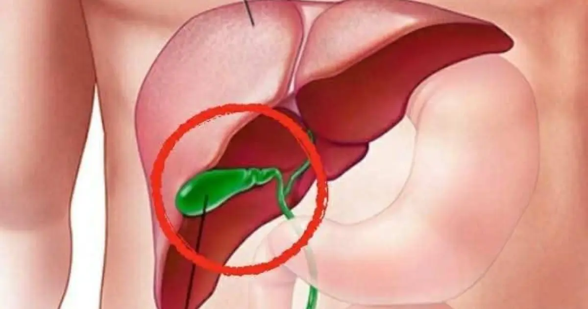 After Gallbladder Removal: 3 Conditions You Could Develop!