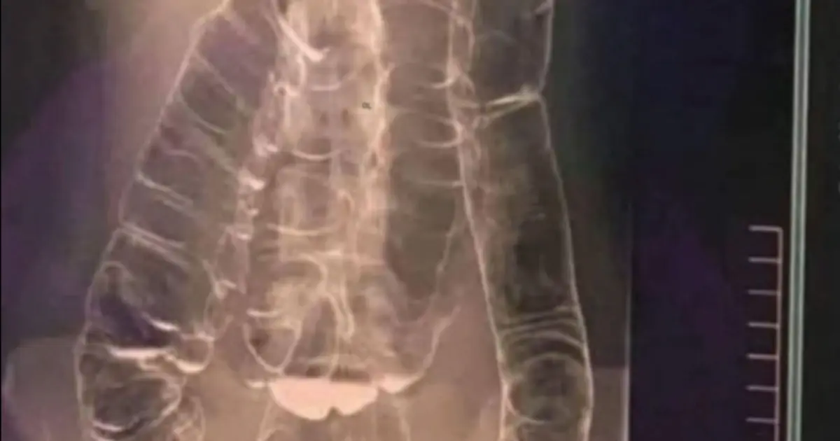 Here’s What You Need To Know About Chronic Constipation: A Silent Threat To Digestive Health
