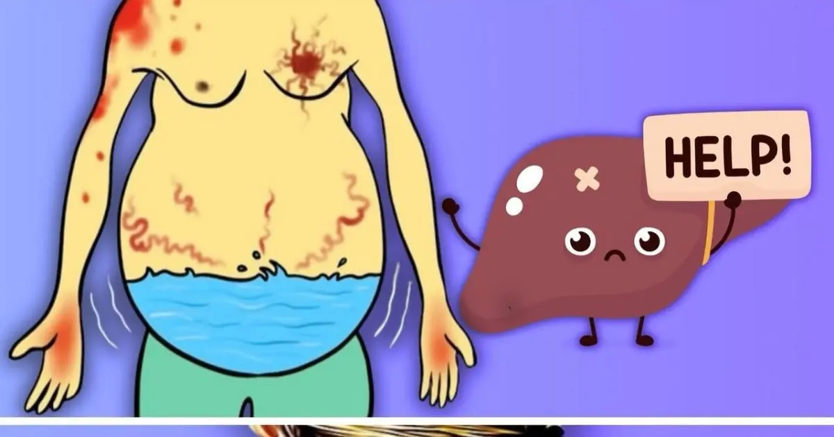 5+ Silent Symptoms of Fatty Liver You Must Never Ignore