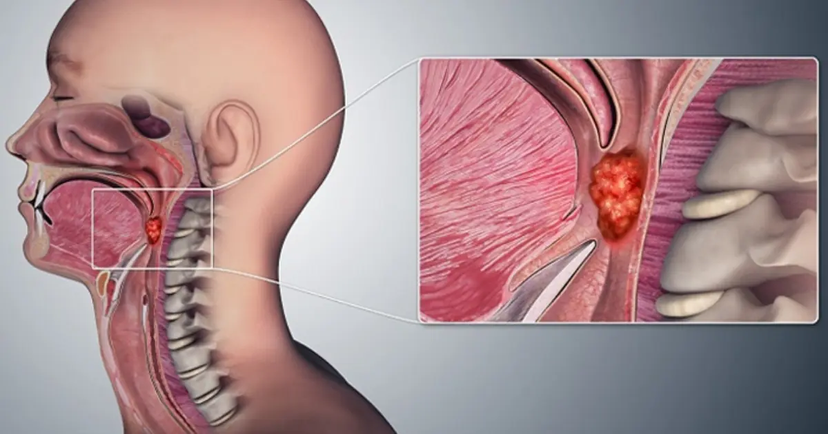 How to Get Rid of Phlegm and Mucus: 6 Ways to Feel Better
