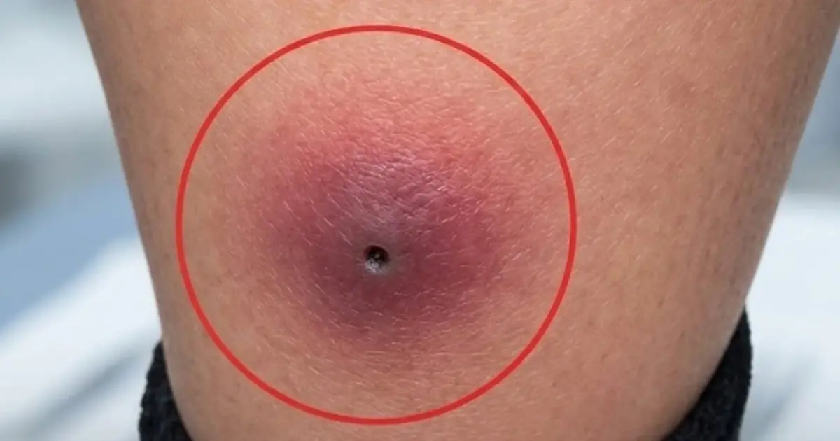 They Thought It Was Only the Flu! After Pulling Up a 12-Year-Old Boy's Pant Leg, the Doctor Immediately Sent Him to the ICU.