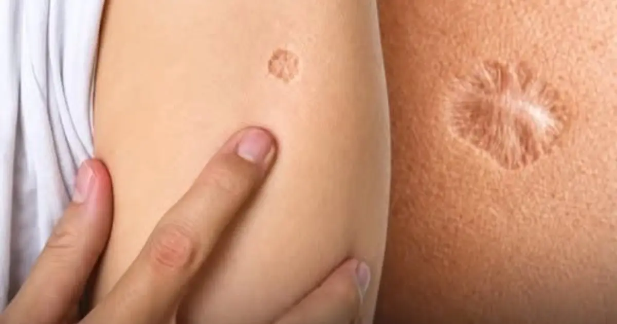 Millions of People Have the Same Small Scar on Their Arm — Here’s What It Really Means