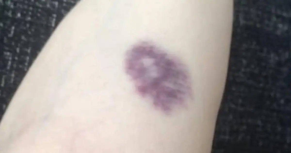 BE CAREFUL: If You Notice These Unusual Bruises on Your Body, Don’t Ignore Them...