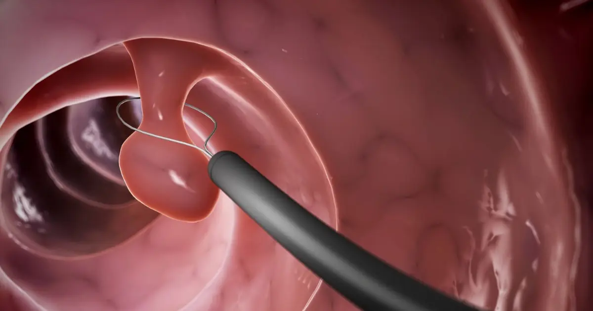 Colon Polyps: Why Finding Them Early Can Be a Crucial Step in Can.cer Prevention