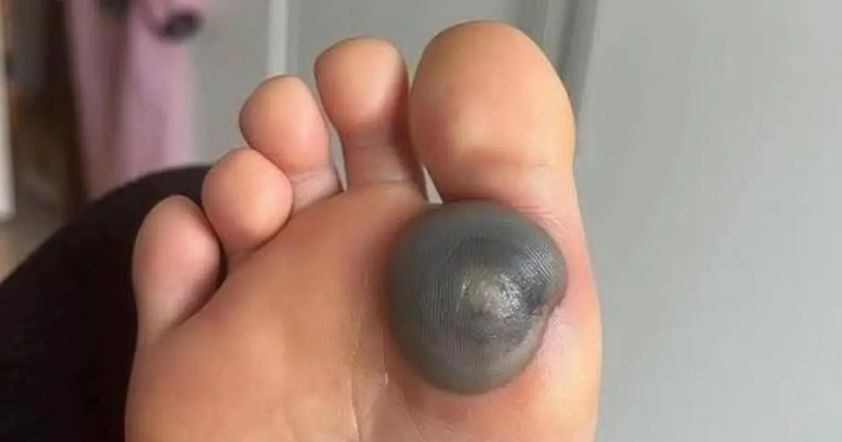 My Daughter Woke Up With This Huge Spot on Her Foot – What Could It Be?