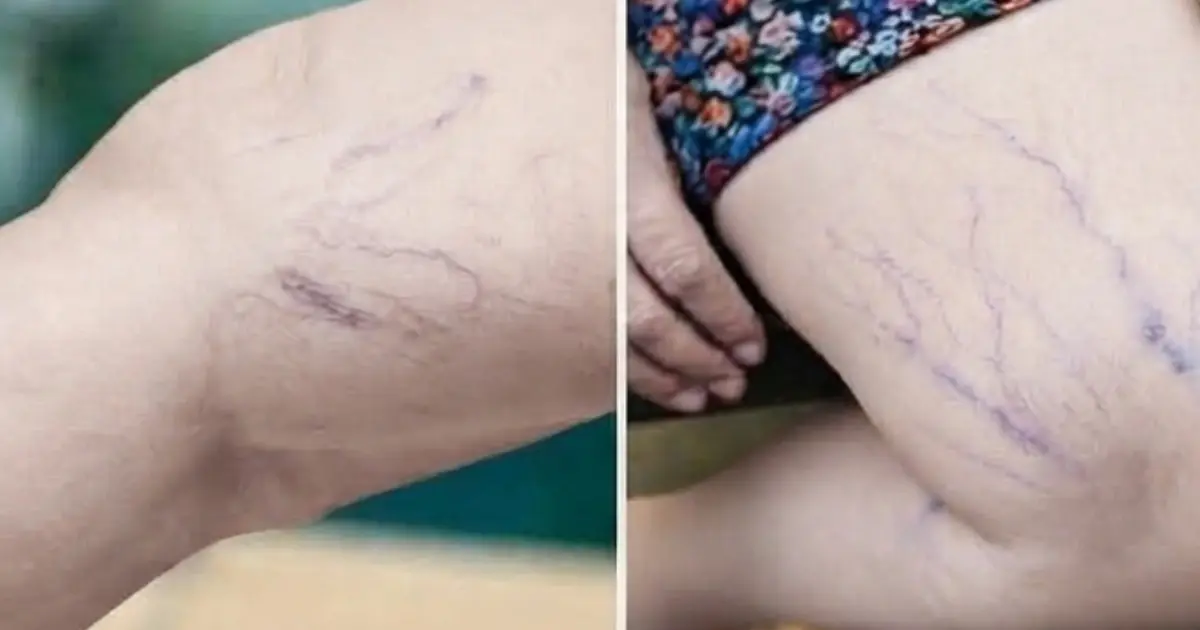 Noticed Purple Lines on Your Legs? They May Be Telling You Something