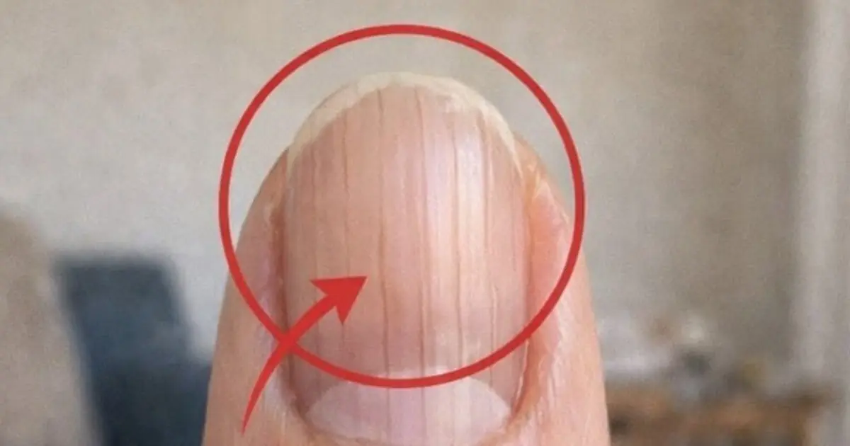If you have these lines on your nails it is a clear sign that... see more 👇👇