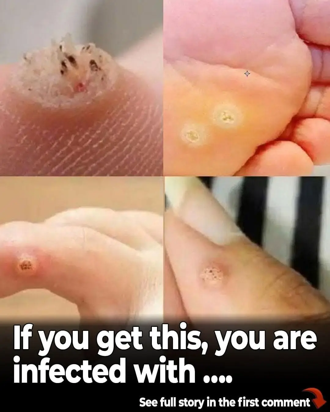 Understanding the 6 Types of Warts: Signs, Symptoms, and How to Treat Them