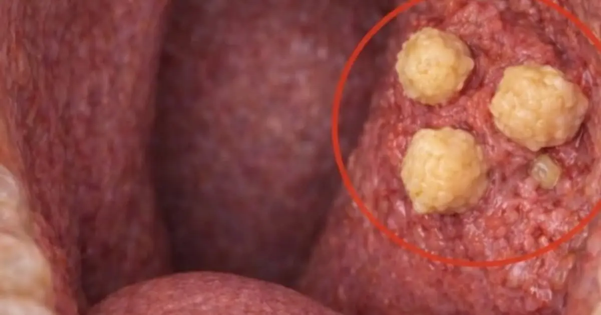What Are Those Small White Stones in Your Throat That Cause Bad Breath?