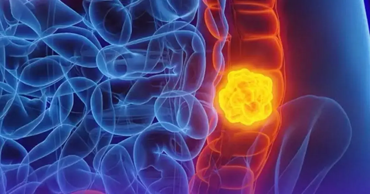 Woman Shares Five Symptoms She Ignored Before a Late-Stage Colon Cancer Diagnosis
