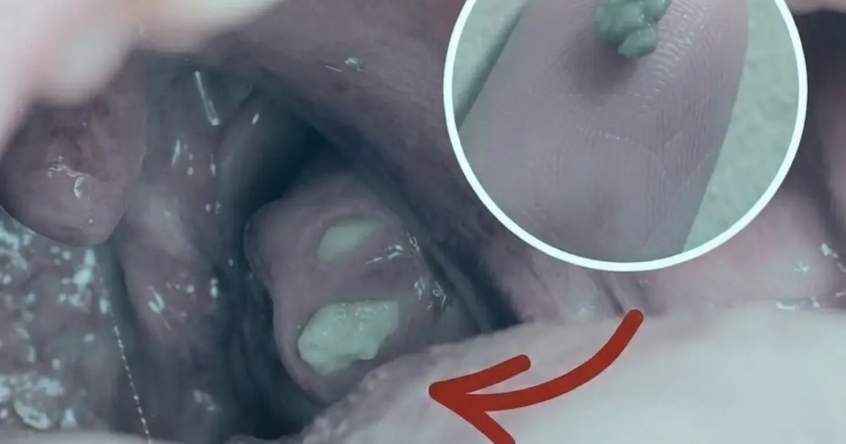 Tonsil Stones: What Are Those Small White Lumps Hiding in Your Throat?