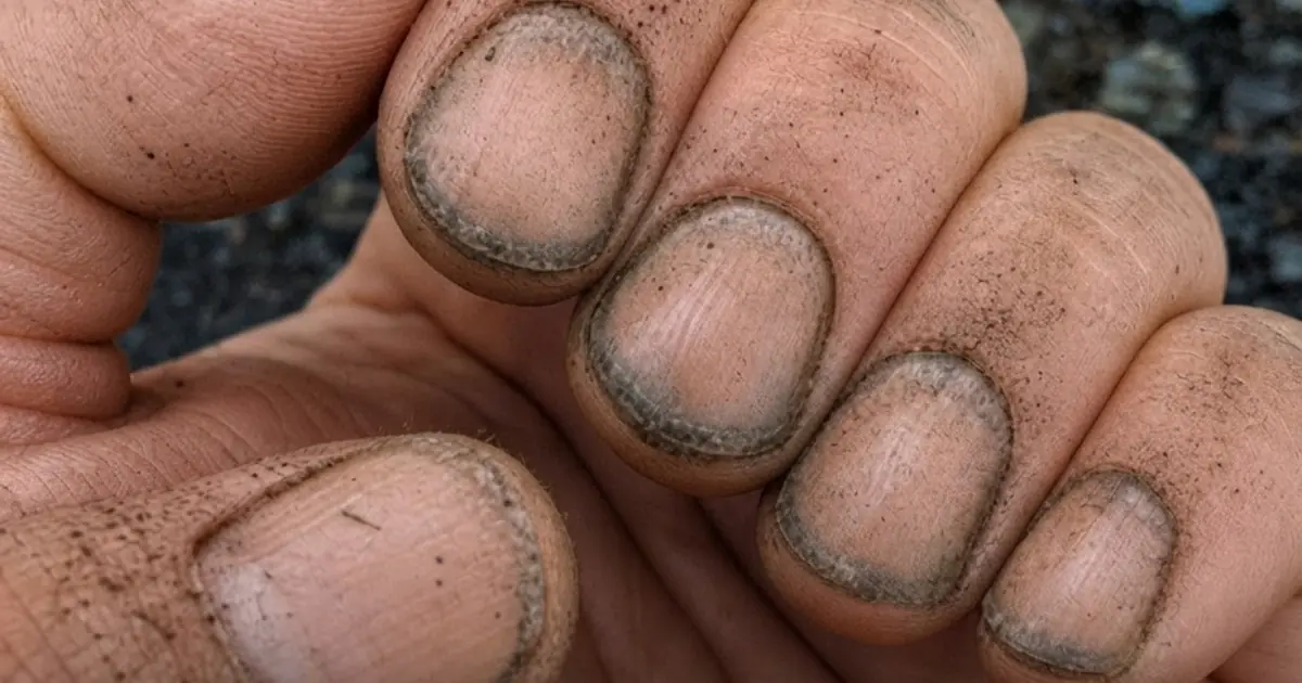 What Could Dirty, Dark, or Unusual-Looking Nails Be Telling You?