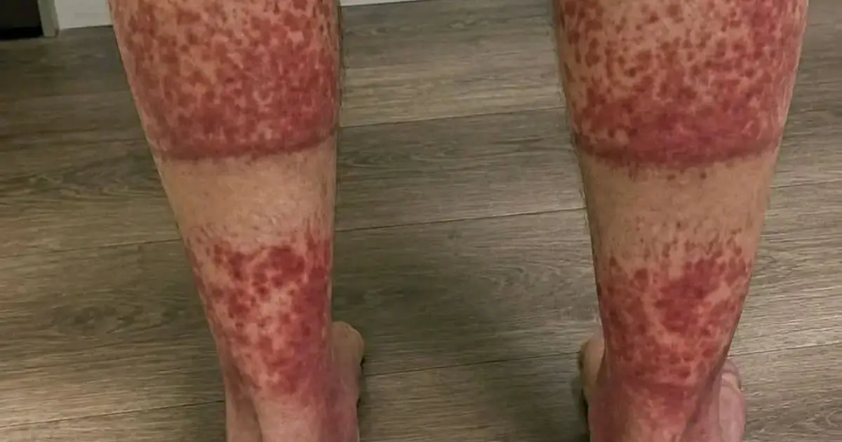 Strange Red Spots on Your Legs? Your Skin May Be Sending You a Warning Sign