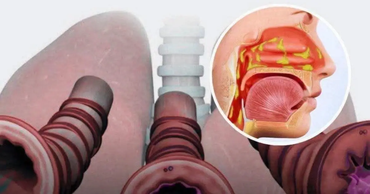 How to Get Rid of Phlegm and Mucus in Your Chest and Throat