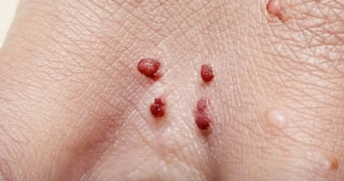 See Tiny Red Bumps Appearing on Your Skin? There Are Several Possible Reasons