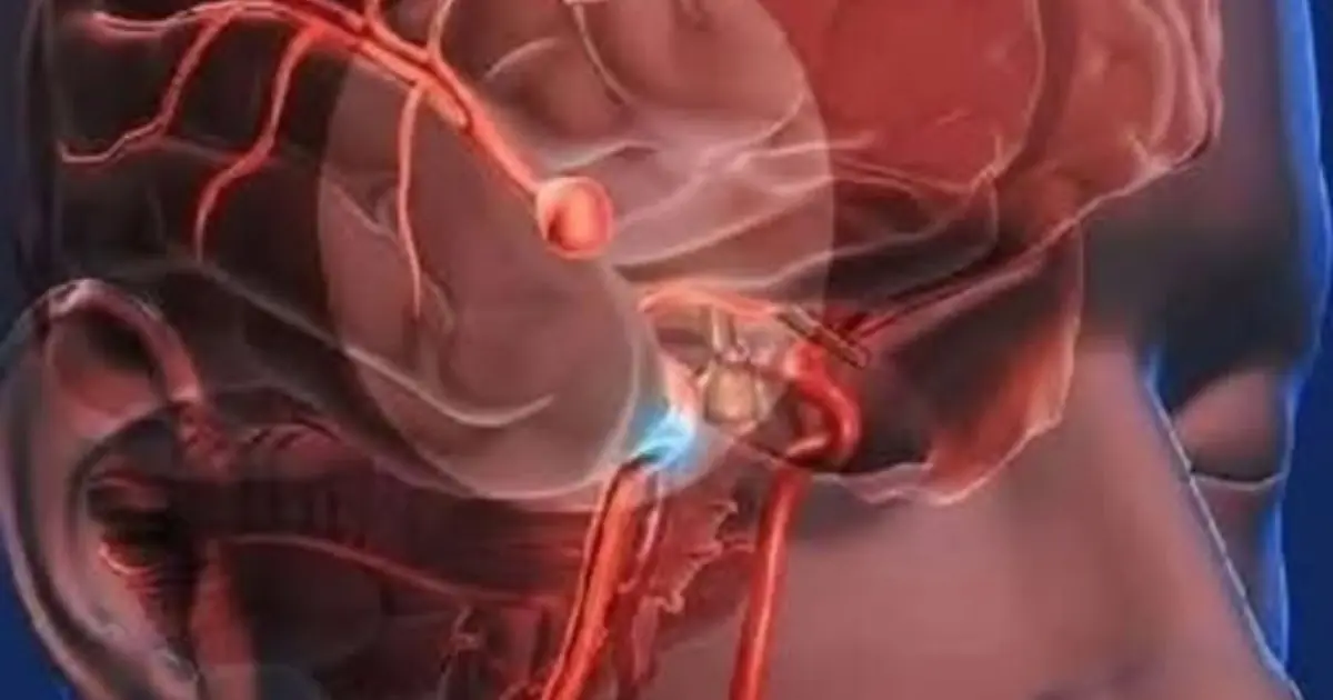 Aneurysm: Signs you shouldn't ignore... See more