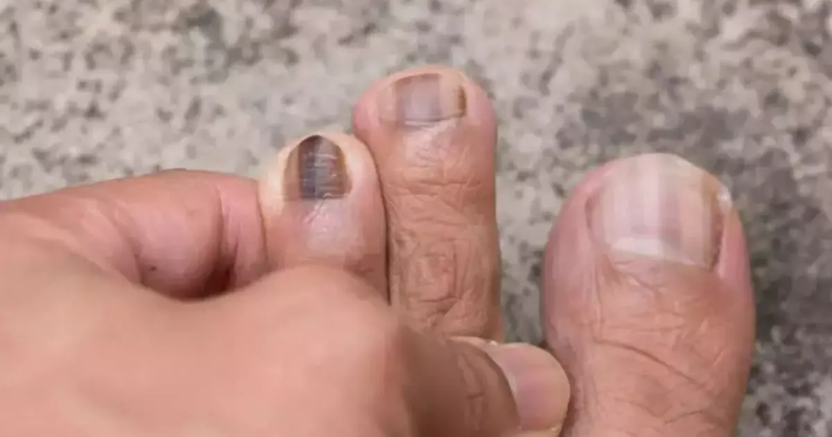 Notice These 12 Changes in Your Feet? They Could Be Related to Bl00d Sugar Problems