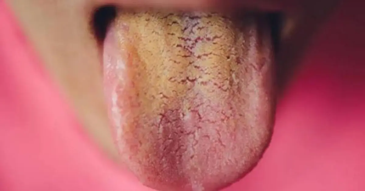 Notice a Yellow Tongue? Don’t Ignore These 5 Possible Causes