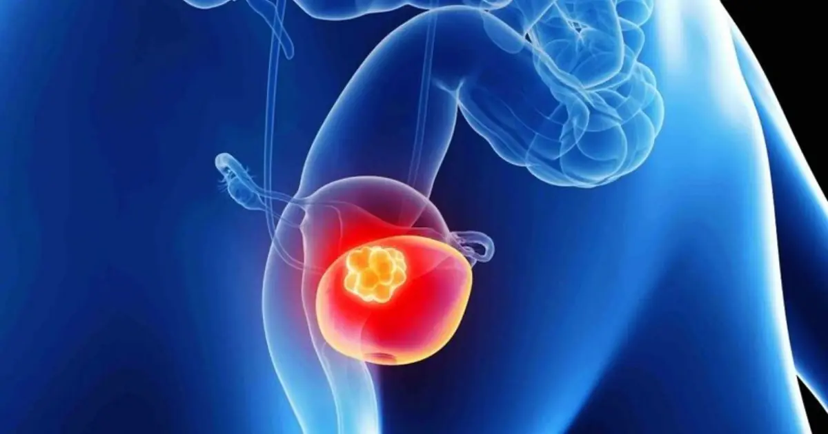 Doctors Reveal the Early Symptoms of Bladder Can.cer You Should Know About