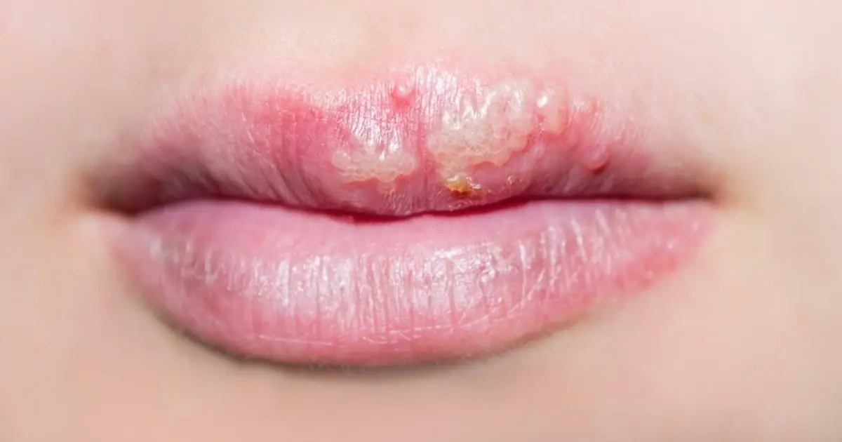 White Marks on Your Lips or Inti.mate Area? Possible Causes to Know