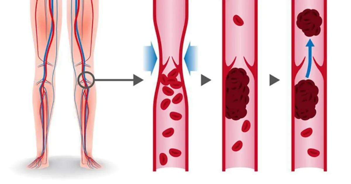 Your Feet Could Reveal Clues About Your Artery Health - Here’s What to Watch For